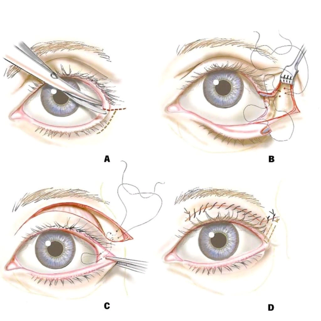 Изменение формы глаза. Кантопексия, кантопластика (подтяжка угла глаза). Операция латеральная кантопластика. Кантопексия миндалевидные глаза. Латеральная кантопластика глаз.