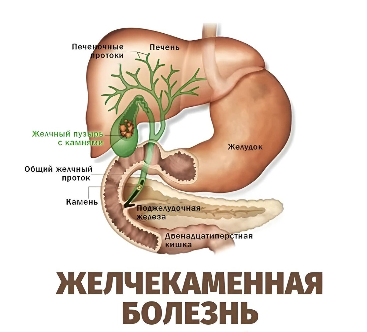Баня желчный пузырь. Анатомия ЖКТ желчный пузырь. Желчный пузырь и желчные протоки анатомия. Камни поджелудочной железы ЖКБ. Желчекаменная болезнь анатомия.